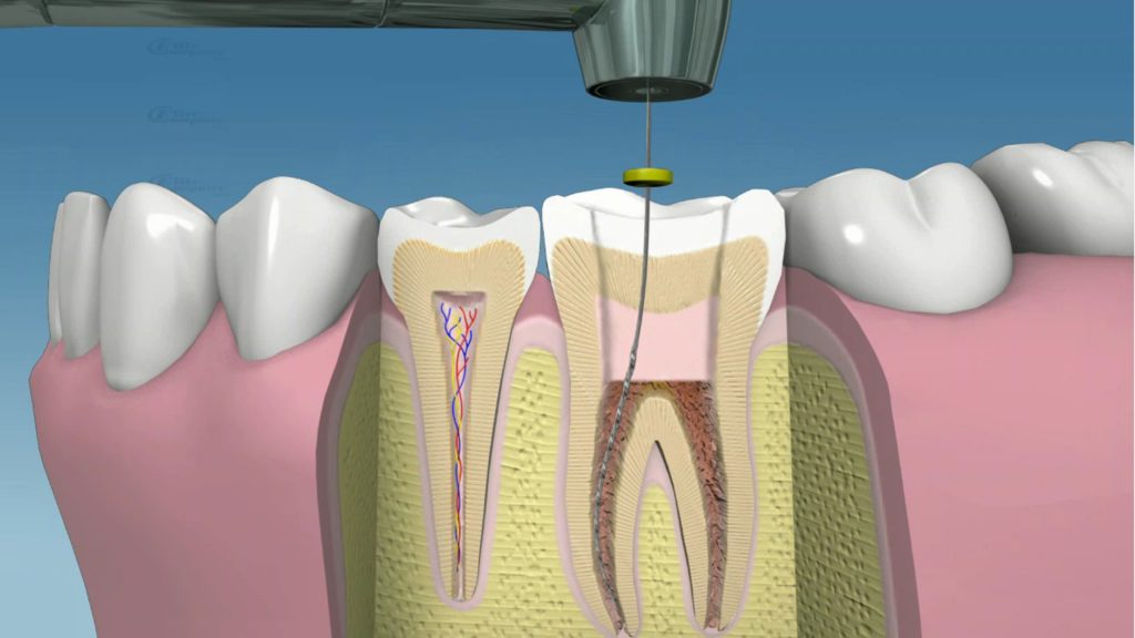 endodoncia mecanizada