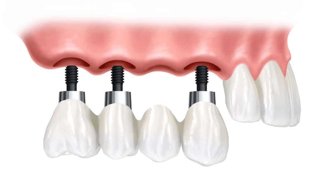 ¿Cuánto dura un implante dental?