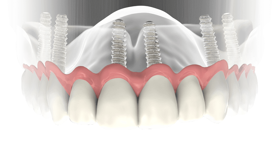 Implantes dentales en Madrid