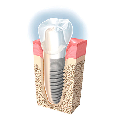 Implantes dentales en las rozas madrid