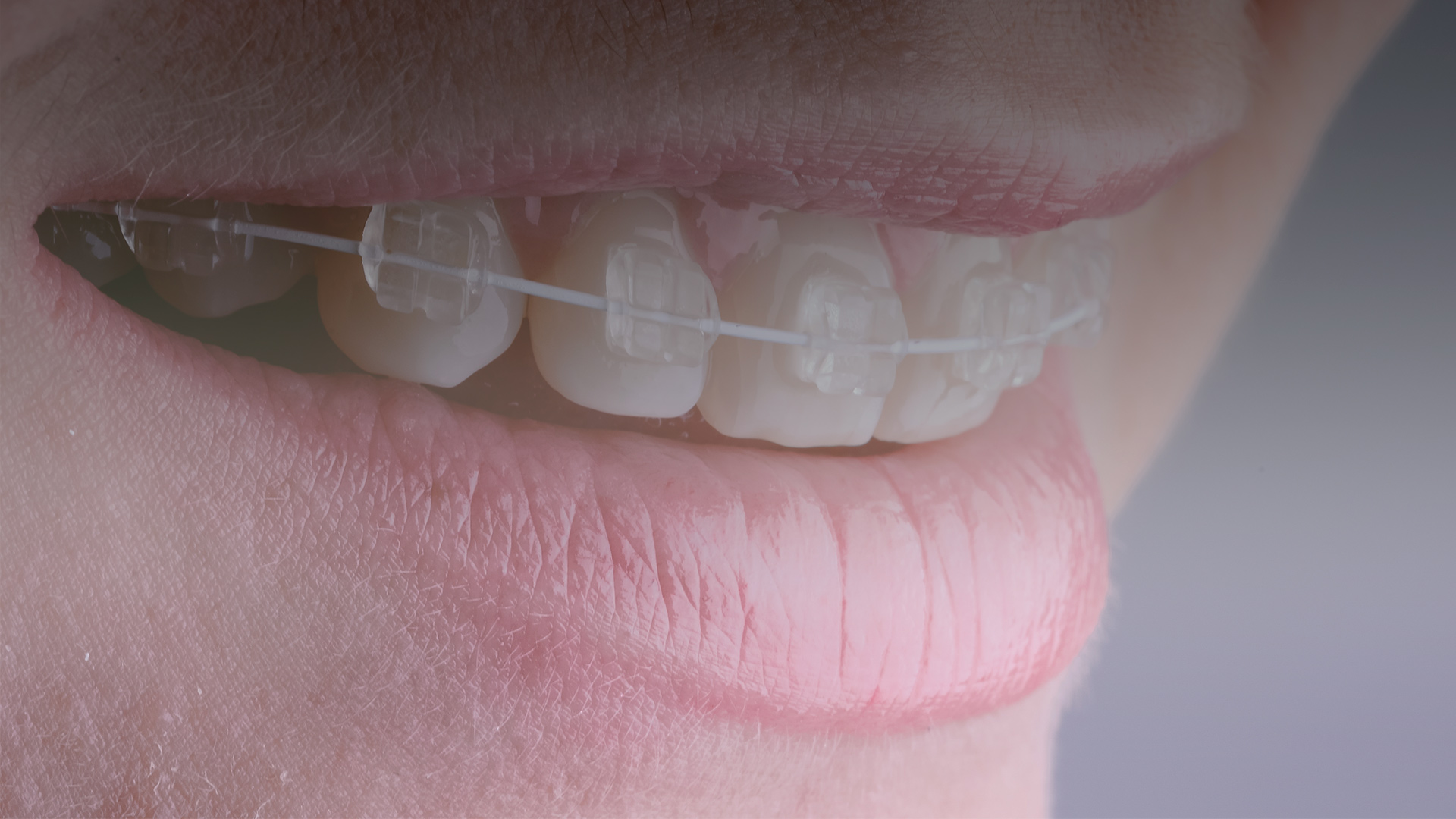 Ortodoncia braquets estéticos Clinica dental Zendental