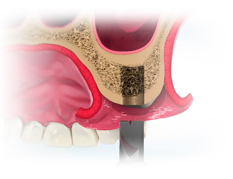 implantes dentales las rozas tipos de implantes dentales expansión cresta ósea