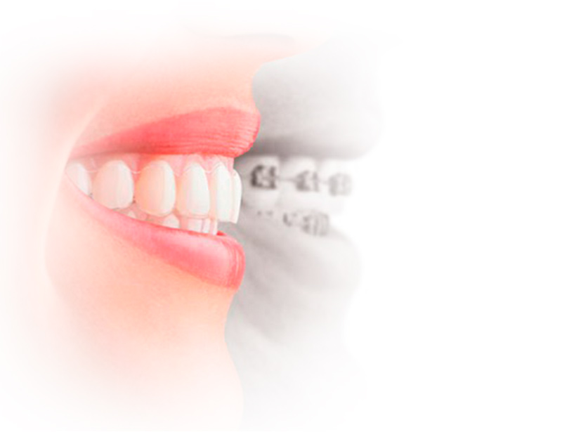 beneficios de la ortodoncia invisible