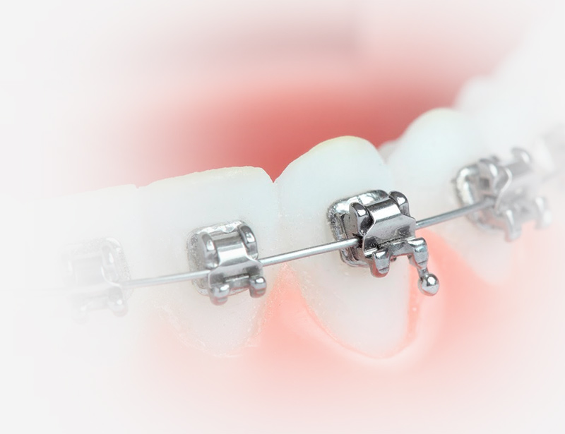 Cómo funciona la ortodoncia autoligada