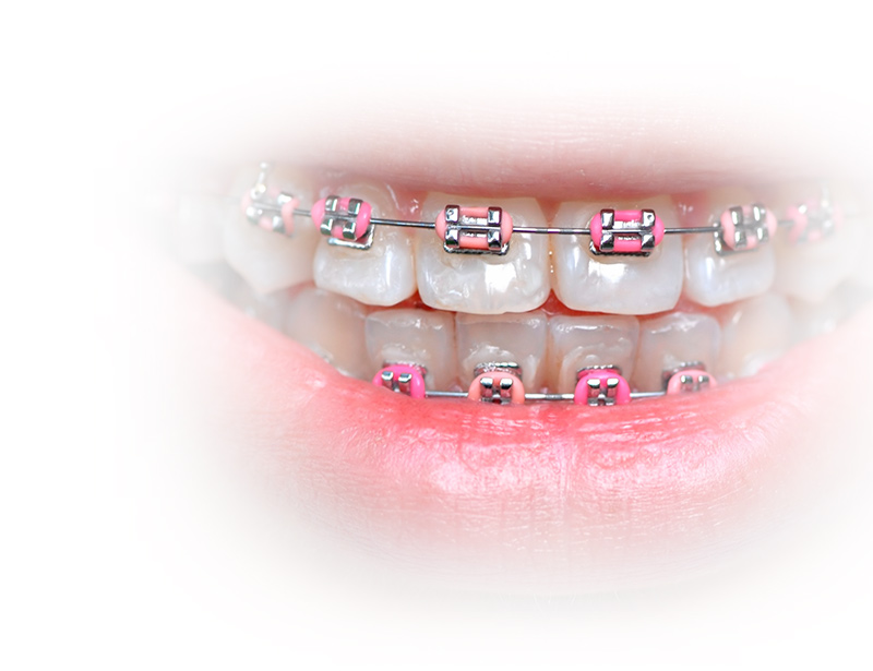 ortodoncia correctiva en adolescentes