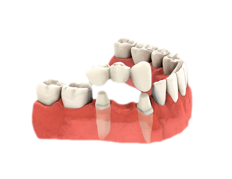 Qué es un prótesis fija | puente dental