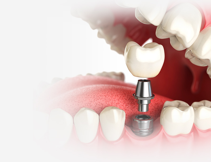 Beneficios de la prótesis dental | Ventajas fundas dentales
