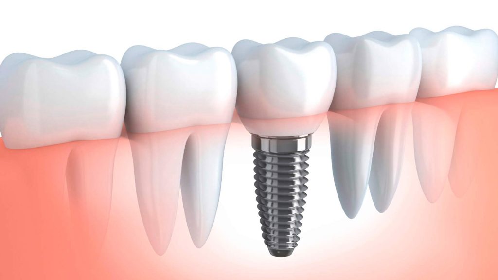 Complicaciones comunes en implantes dentales
