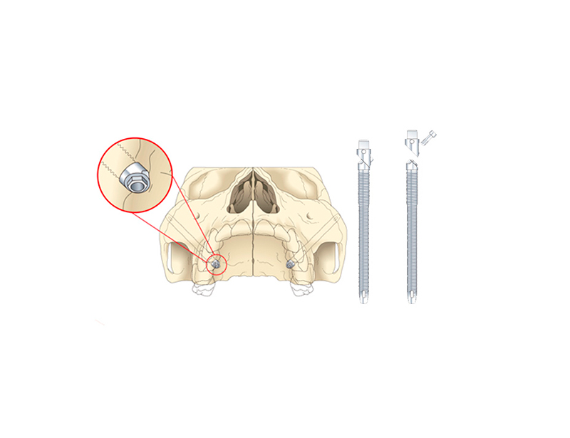Los implantes cigomáticos permiten la carga inmediata de la prótesis