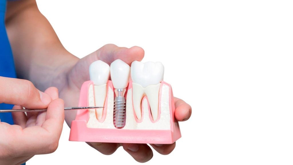¿Te vas a poner un implante dental? Lo que debes saber