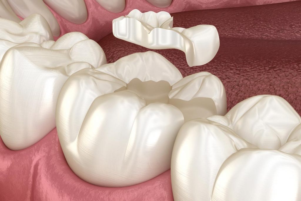 Tipos de incrustaciones dentales