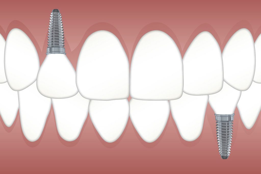 Implantes dentales para pacientes que necesitan sedación consciente