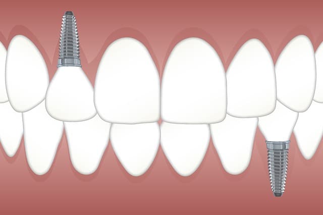 ¿Cuánto hueso se necesita alrededor de un implante dental?