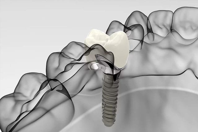 La importancia de la corona dentro de un implante dental.