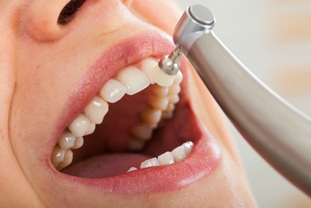 Blanqueamiento dental en Las Rozas ¿Cuánto tiempo dura?