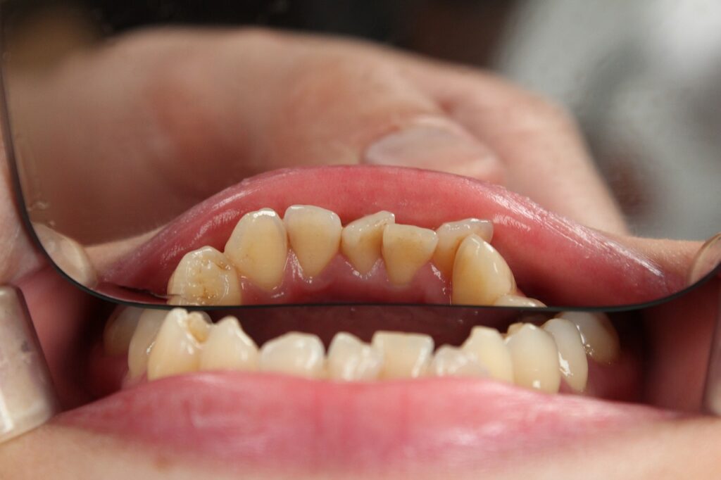 Apiñamiento dental: cómo se puede solucionar