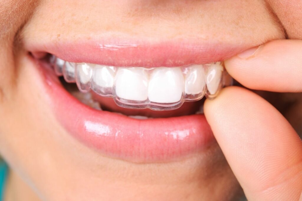 Qué hacer si se han movido los dientes luego de la ortodoncia