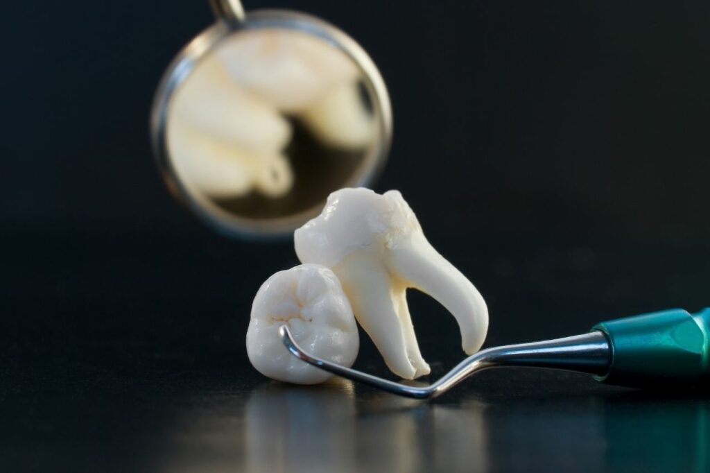 es necesario extraer las muelas del juicio para la ortodoncia
