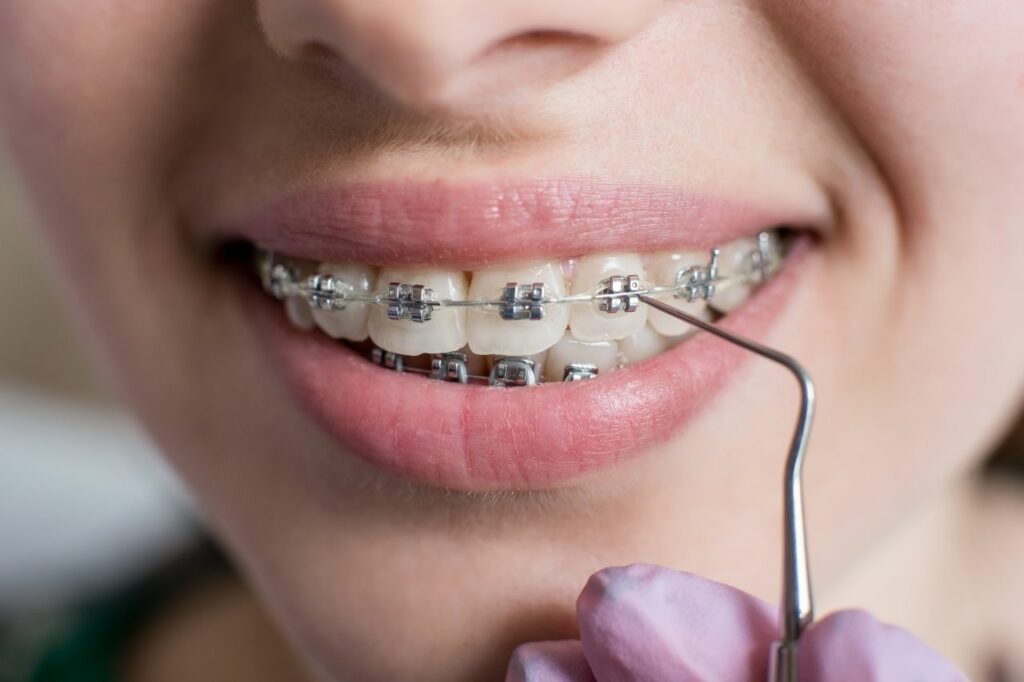 ortodoncia cuando faltan piezas dentales