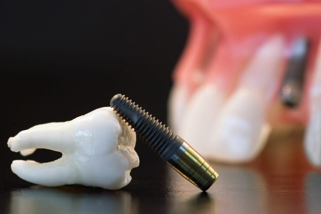 qué hacer en casos de rotura del tornillo de un implante dental