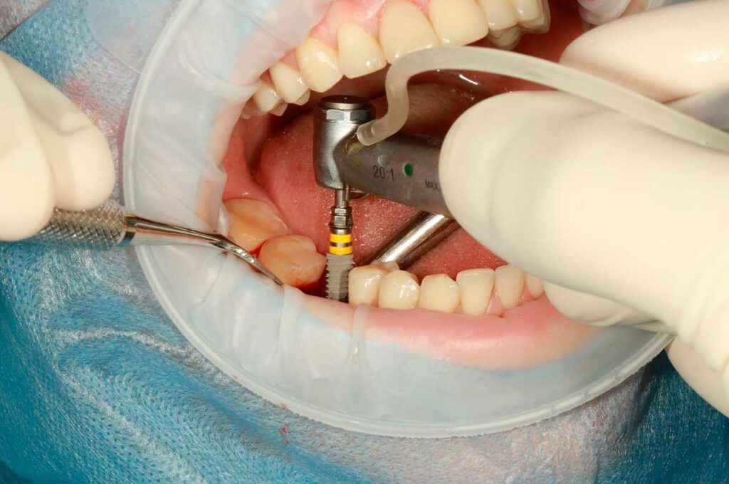 Necrosis dental: qué es y su solución